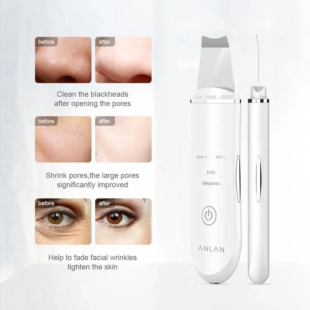 Ultrasonic Skin Scrubber Pen Face Cleansing Dead Skin Remover